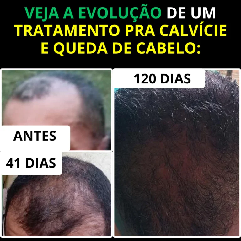 Caso de calvície 1 — antes e depois