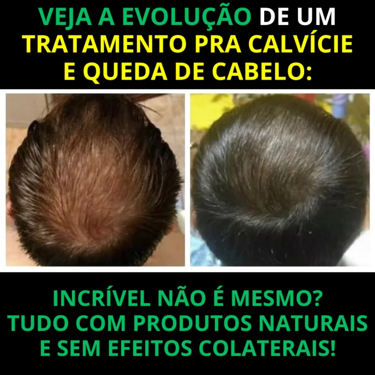 Caso de calvície 2 — antes e depois