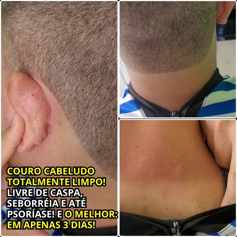 Wendel Depois do Tratamento